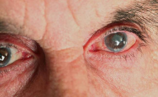 Врач рассказал об основных способах профилактики глаукомы и борьбы с ней