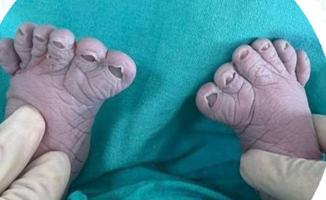 В российском городе родился ребенок с 12 пальцами на ногах